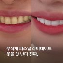강남심미치과 | 강남치과 추천 무삭제 퍼스널 라미네이트 내돈내산 후기 자연스러운 앞니 개선 만족