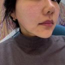 변피부과의원 | 신논현피부과 필로드2cc 쁨의원 찐후기 (리쥬란 비교)