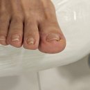 레푸스 정자점 | 분당 내성발톱 관리 레푸스 정자점 이유진 푸스플레게 후기