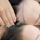 대평동_해들 518동 앞 | 세종 대평동 여자 헤어라인 문.신 | 라비아 뷰티랩