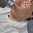 천안 피부과 리쥬란HB 2cc, 에버클, 시너지 부스터 후기 (통증, 관리법, 전후사진)