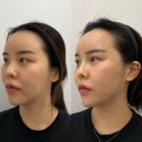 운정 성형외과ㅣ운정 텐써마 300샷 30대 여성 후기ㅣ텐써마효과 주의사항