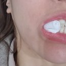 11305-8-300-1 | 명동 피부과 볼뉴머 300샷 내돈내산 후기 (ft. 효과/가격/주기/통증/팔자주름)