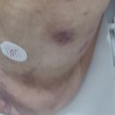 PCN | 남양주 현대병원 입원후기 YTN 결박 보도