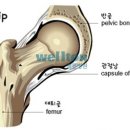 [고관절인공관절] 고관절 재수술 원인 1위 탈구, 근육-힘줄보존 수술법으로 예방 이미지