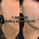 부산 구서동 피코토닝 레블라이트 SI 레이져 기미치료 잘 하는 jk맑은피부과의원