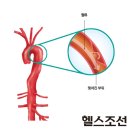 3.혈관건강 맥을 짚어라 이미지