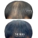 도치도트 탈모 두피케어 속눈썹 | [공지] 모발이식 후 1년 뒤 모습…영등포 당산역 도치도트에서 탈모 해결한 후기!