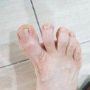 사례) 무지외반증에 좋은 슈올즈 신발 솔직후기~~