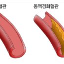 동맥경화를 이겨내자 이미지