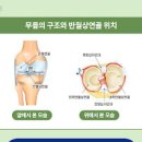 반월상 연골 파열 증상 및 수술 (무릎 연골 찢어짐, 안쪽 통증) 이미지