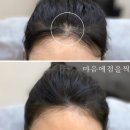 마음에 점을찍다 광주본점 SMP 두피