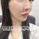 서울시청 | 옆 볼패임 쥬베룩 볼륨 고민 후기 | 서울 시청피부과