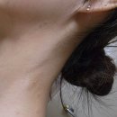 전근택피부과의원 | 전근택피부과에서 점 빼기