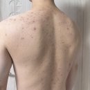 정수한의원 | 노원 여드름한의원에서 등 자국 흉터 율각테라피6세트 치료받은 후기