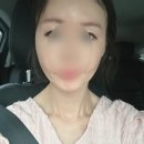 셀업성형외과의원 | 남양주 별내 슈링크유니버스 +아이슈링크 내돈내산 후기