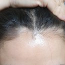 양내과의원 | [부산] 망미동 자혜내과의원 탈모 6주 변화 솔직 후기 내돈내산