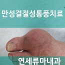 [창원 관절류마티스내과 연세류마내과(구.연세편한마디내과)] 통풍약 안아픈데 평생 먹어야되나요?