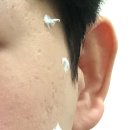 명동미소유의원 | 얼굴 점빼기, 얼굴 점제거 시술 (명동미소유 의원)