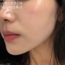 스토리 멍 | 부산서면스킨부스터 셀르디엠 내돈내산 1개월차 후기! | 붓기, 멍, 효과, 팔자주름