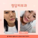 청담약국 | 청담피부과 줄기세포주사 셀빅스주사 스킨부스터 효과 가격 후기