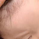한강수병원 | 한강수병원 18개월 아기 봉합수술_2일후 수술,레이저치료X(봉합시기, 비용, 수술과정)