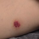 연세광정신건강의학과 | 대상포진 생기는 이유? 실제 경과후기 갑작스러운 허벅지 붉은 반점
