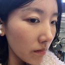 야금야금 | 30대 야금야금 시술 추천 리스트 - 세르프 리프팅, 골드 PTT, LDM 레이저 내돈내산 후기