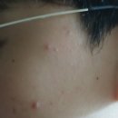 클린큐어 아레 사용 후기~~