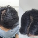 대인카클리닉 | 트리코닉스 트리코엑스 두피앰플 탈모에는 무화과엑소좀이 정답
