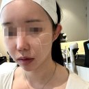 신사 올타이트 400샷 하프해진 이중턱 전후O 피부클리닉의원 후기 (가격·유지기간·효과)