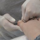 레푸스 구월점 내성발톱 무좀발톱 발각질 문제성발 | [인천내성발톱 구월동]내 발의 모든 문제, 정밀 측정으로 뿌리 뽑는 '레푸스 구월점'