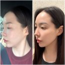 닥터영의원 | 닥터손유나의원 코셀라리프팅 2회차 내돈내산 후기