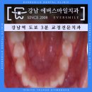 에버덴트치과기공소 | 돌출입 교정 기간 급속으로 안전한 과정