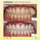강남역치아미백 효과 좋은 곳 후기 전후 비교