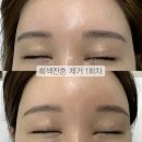 솔앤브로우 | 일상생활 가능한 안양잔흔제거 안양눈썹문신제거 솔앤브로우