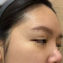 채피부과의원 | 영등포 피부과 추천, 사려니 의원, 편평사마귀 제거 후기, 내돈내산