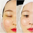 진성컴인 | 잠실피부관리 샵 쁘띠팰리스 잠실점 - 여배우 작은 얼굴관리 후기