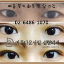 한영안과의원 | 매몰쌍수후기 예뻐졌대요~♡