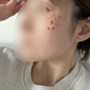 이종원가정의원 | <6개월,1년 후 후기추가!!>인천 점신 <이종원가정의원>점만 빼러 갔다가 잡티 전부 빼고 왔다. <칼국수...