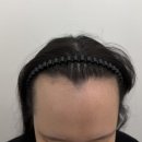 LUAR | 부산 탈모 두피커버 루아르에서 헤어라인 고민 해결한 후기
