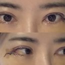 강남 메이드영성형외과 장남 원장님 뒤트임+ 밑트임 눈밑지방재배치 수술