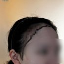 (주)모네상스 | <모발이식> 내가 드디어 모발이식..?? 넓은 이마 + 얇은 모발녀의 모발이식 도전기(1)