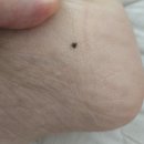 개발바닥 | 발바닥 점 제거 후 조직검사 + 사마귀 냉동치료
