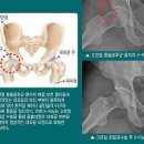 엉덩이 통증 방법 고관절 엉치뼈통증 원인 척추관 협착증 천골염 고관절 대퇴비구 충돌증후군 이미지