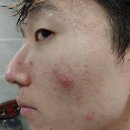 좁쌀 여드름화장품 사용 후기! 효과 없으면 100% 환불?