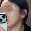 사항 | 써마지가격 상담 과정 주의사항 써마지후기