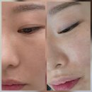 지나에스테틱 - 강남구 압구정로 461 | 상인동피부관리 여름철 피부관리 소연에스테틱 바이오리필 후기