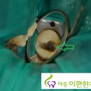 아중이편한치과 네이버블로그
