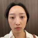 오투피부과의원 | 출산후 급노화, 종로피부과 티타늄리프팅 후기